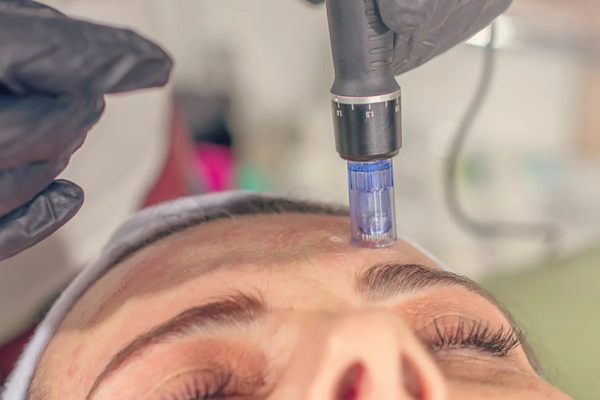 Mikrojehličková radiofrekvence: Omlazující procedura obličeje - foto 07