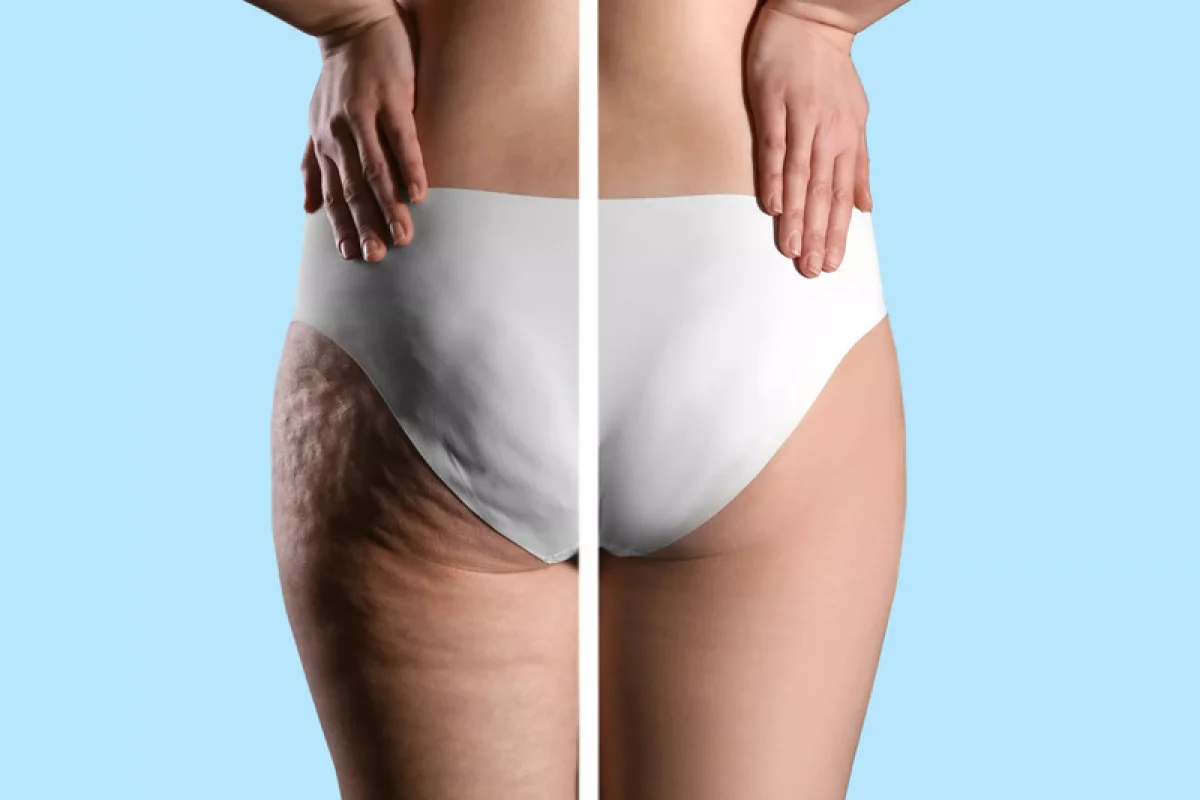 Neinvazivní liposukce: Ultrazvuková kavitace - foto 04